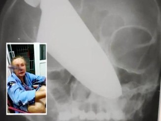 Wanita Terselamat Setelah Pisau Tembus Wajahnya