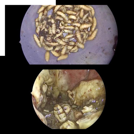 150 Ulat Bersarang Daripada Hidung Lelaki