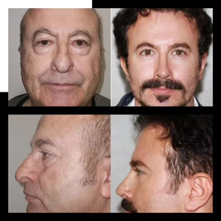 Lelaki Muda Berpuluh Tahun Selepas Pembedahan